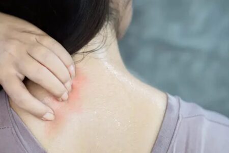 夏の首の荒れ☆