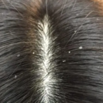 細かいフケは☆