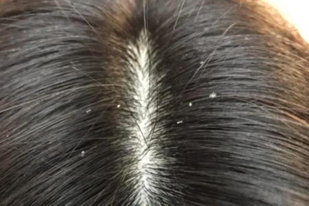 細かいフケは☆